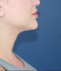 Feel Beautiful - Neck Lipo San Diego - After Photo